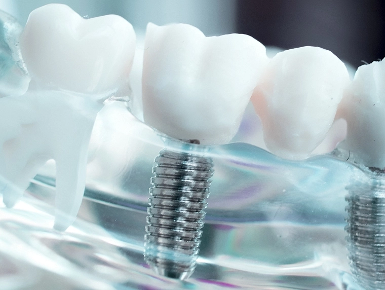 Periodoncia