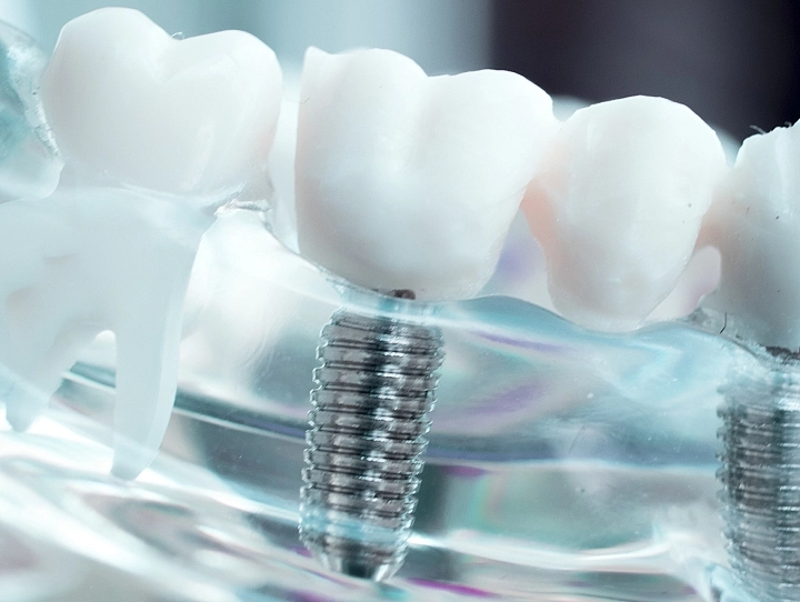 Periodoncia profesional en Zamora